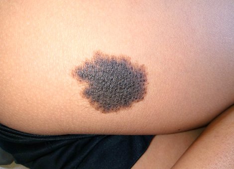 10 People Turned Their Birthmarks Into Tattoos  DeMilked